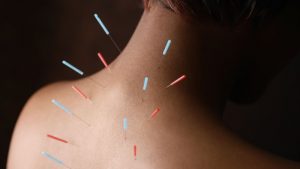 How Effective Is Acupuncture?